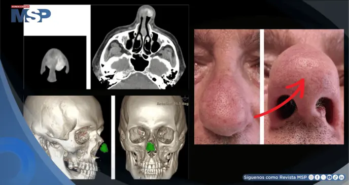 Detectan en hombre con gota crónica un bulto nasal causado por acumulación de cristales de ácido úrico