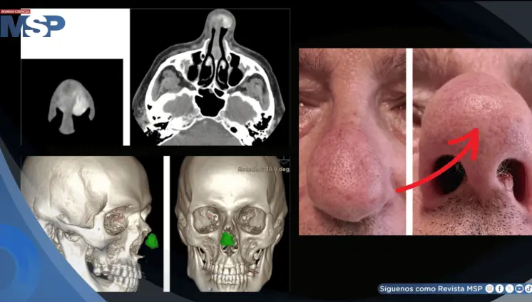 Detectan en hombre con gota crónica un bulto nasal causado por acumulación de cristales de ácido úrico Detectan en hombre con gota crónica un bulto nasal causado por acumulación de cristales de ácido úrico