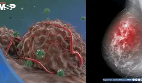 Descubren que el cáncer de mama resistiría las terapias hormonales gracias a la proteína FOXA1