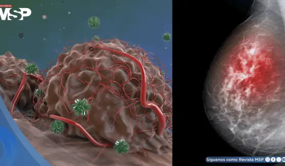 Descubren que el cáncer de mama resistiría las terapias hormonales gracias a la proteína FOXA1
