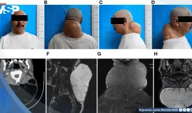 Detectan lipoma gigante posterior del cuello de 20 cm con características adiposas encapsuladas