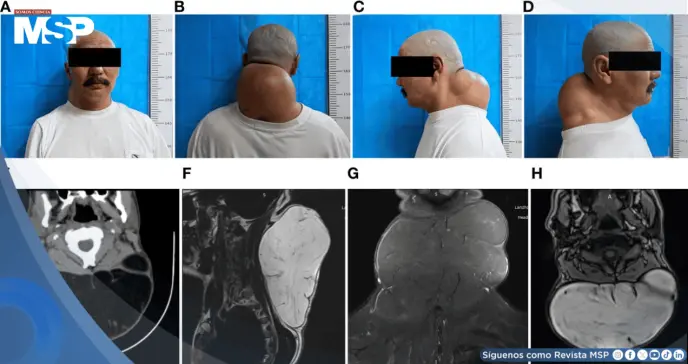 Detectan lipoma gigante posterior del cuello de 20 cm con características adiposas encapsuladas Detectan lipoma gigante posterior del cuello de 20 cm con características adiposas encapsuladas