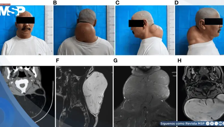 Detectan lipoma gigante posterior del cuello de 20 cm con características adiposas encapsuladas Detectan lipoma gigante posterior del cuello de 20 cm con características adiposas encapsuladas
