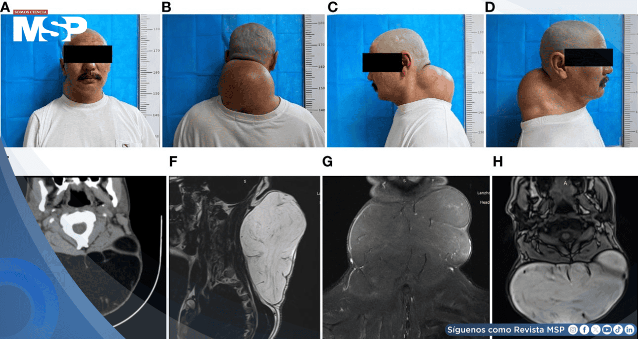 Detectan lipoma gigante posterior del cuello de 20 cm con características adiposas encapsuladas Detectan lipoma gigante posterior del cuello de 20 cm con características adiposas encapsuladas