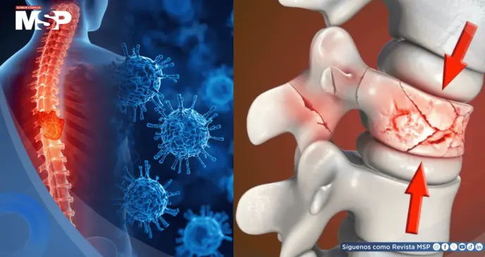Científicos logran curar fracturas de columna con células madre de grasa corporal