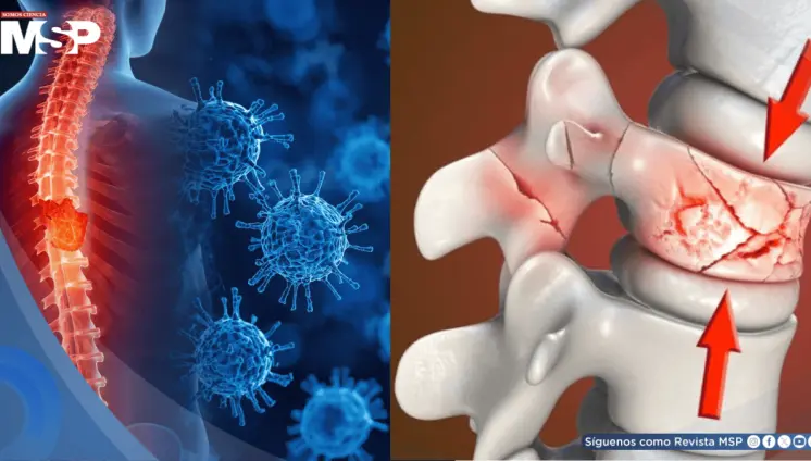 Científicos logran curar fracturas de columna con células madre de grasa corporal
