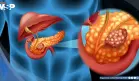 Agrandamiento del conducto pancreático podría ser una señal temprana de cáncer de páncreas