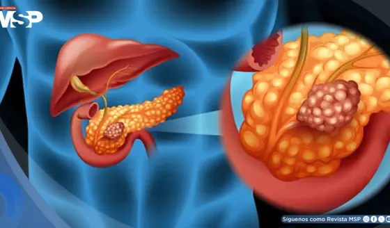Agrandamiento del conducto pancreático podría ser una señal temprana de cáncer de páncreas