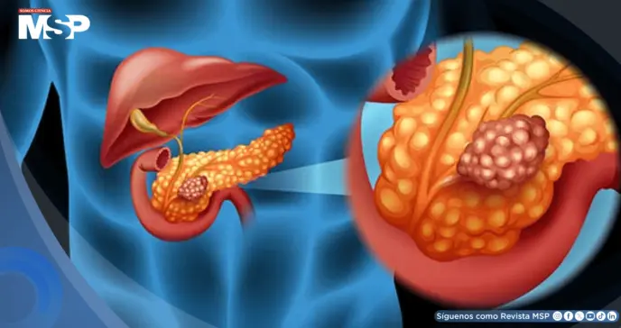 Agrandamiento del conducto pancreático podría ser una señal temprana de cáncer de páncreas Agrandamiento del conducto pancreático podría ser una señal temprana de cáncer de páncreas