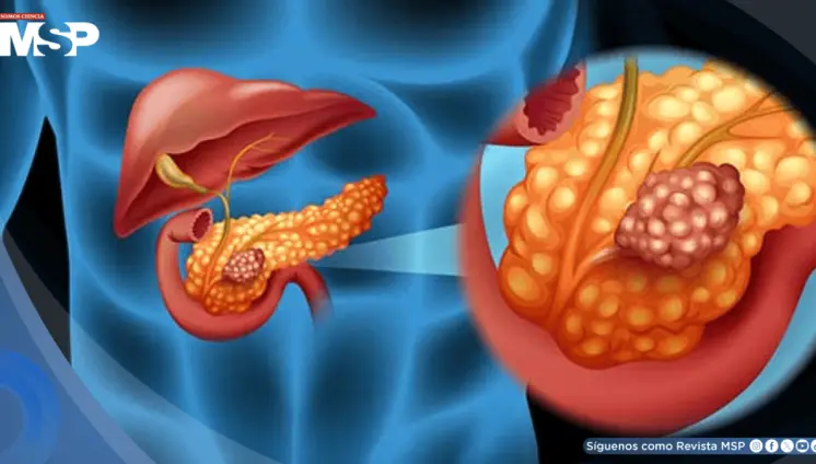 Agrandamiento del conducto pancreático podría ser una señal temprana de cáncer de páncreas