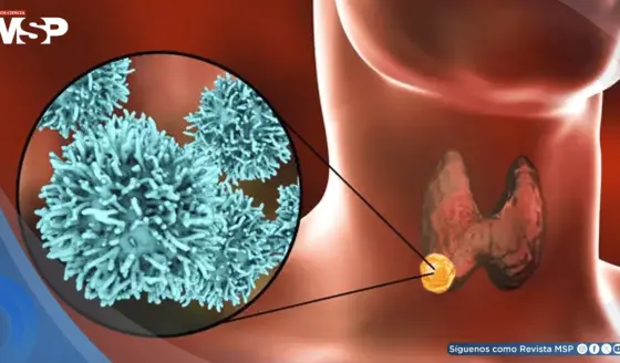 El cáncer de tiroides estaría aumentando: ¿sobrediagnóstico, obesidad o disruptores endocrinos?