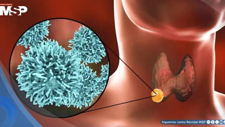 El cáncer de tiroides estaría aumentando: ¿sobrediagnóstico, obesidad o disruptores endocrinos?
