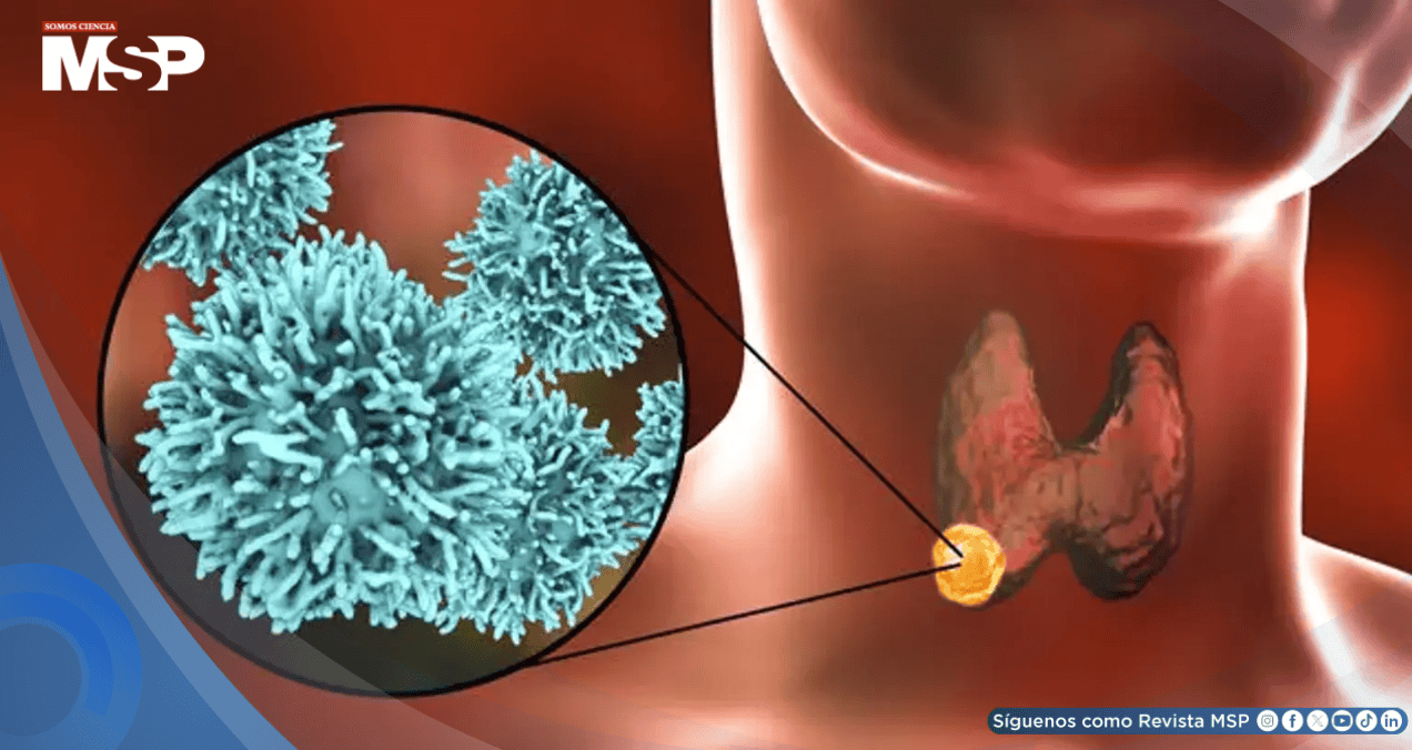 El cáncer de tiroides estaría aumentando: ¿sobrediagnóstico, obesidad o disruptores endocrinos? El cáncer de tiroides estaría aumentando: ¿sobrediagnóstico, obesidad o disruptores endocrinos?
