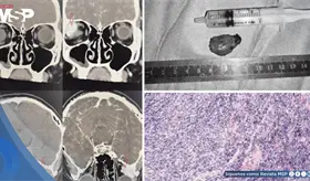 Visión doble reveló un condrosarcoma orbitario inicialmente confundido con hemangioma cavernoso