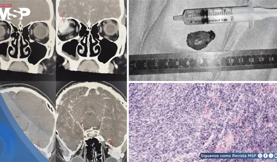 Visión doble reveló un condrosarcoma orbitario inicialmente confundido con hemangioma cavernoso