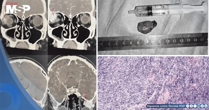 Visión doble reveló un condrosarcoma orbitario inicialmente confundido con hemangioma cavernoso Visión doble reveló un condrosarcoma orbitario inicialmente confundido con hemangioma cavernoso