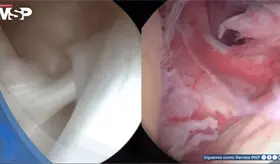 ¿Inmovilidad y dolor sordo en el hombro? Podría ser capsulitis adhesiva u hombro congelado