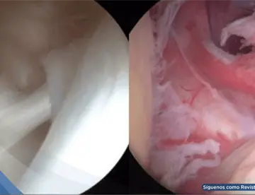 ¿Inmovilidad y dolor sordo en el hombro? Podría ser capsulitis adhesiva u hombro congelado