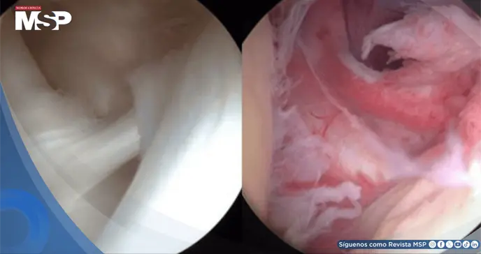 ¿Inmovilidad y dolor sordo en el hombro? Podría ser capsulitis adhesiva u hombro congelado ¿Inmovilidad y dolor sordo en el hombro? Podría ser capsulitis adhesiva u hombro congelado