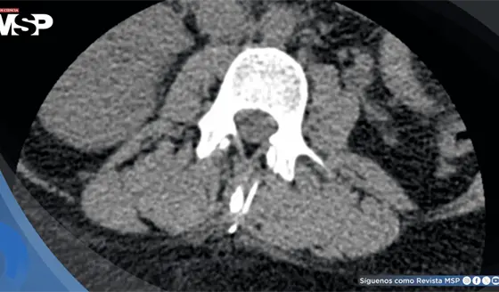 Mujer con escoliosis y obesidad presenta fractura de aguja espinal durante anestesia para cesárea
