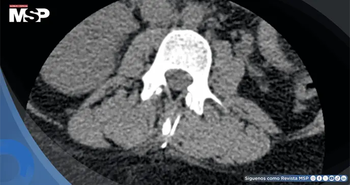 Mujer con escoliosis y obesidad presenta fractura de aguja espinal durante anestesia para cesárea