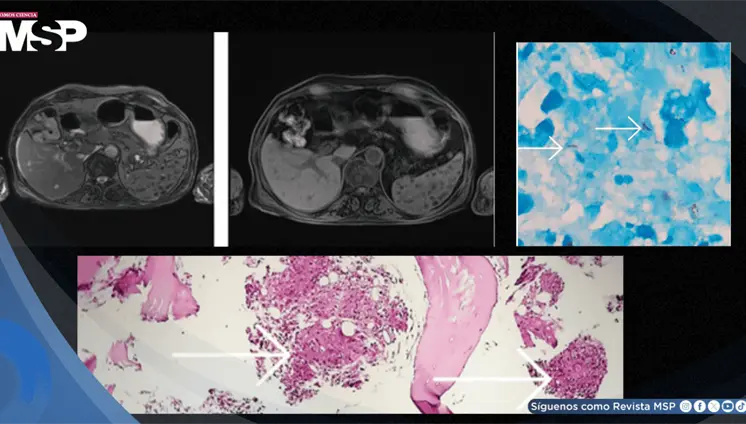 Pancitopenia por tuberculosis con compromiso de médula ósea en paciente con esteroides crónicos
