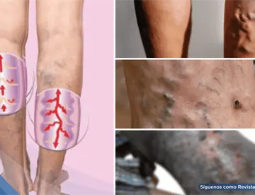 Úlceras varicosas: ¿Qué son, por qué aparecen y cuál es su manejo?