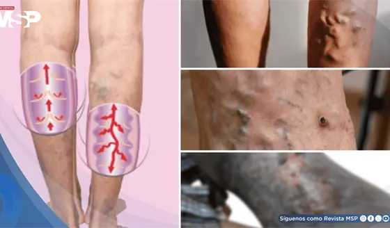 Úlceras varicosas: ¿Qué son, por qué aparecen y cuál es su manejo?
