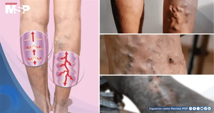 Úlceras varicosas: ¿Qué son, por qué aparecen y cuál es su manejo? Úlceras varicosas: ¿Qué son, por qué aparecen y cuál es su manejo?