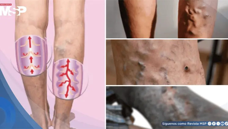 Úlceras varicosas: ¿Qué son, por qué aparecen y cuál es su manejo? Úlceras varicosas: ¿Qué son, por qué aparecen y cuál es su manejo?