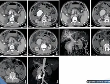 Ictericia, dolor abdominal y heces negras revelan fístula arteriovenosa mesentérica postraumática