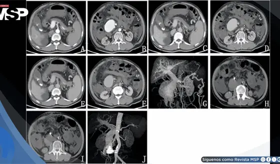 Ictericia, dolor abdominal y heces negras revelan fístula arteriovenosa mesentérica postraumática