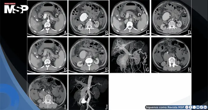 Ictericia, dolor abdominal y heces negras revelan fístula arteriovenosa mesentérica postraumática