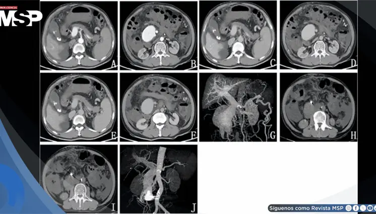Ictericia, dolor abdominal y heces negras revelan fístula arteriovenosa mesentérica postraumática