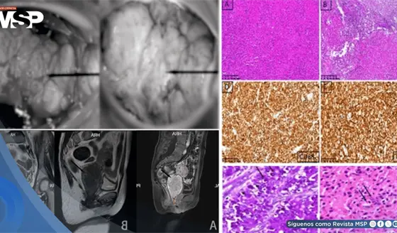 Malacoplaquia cervical simuló neoplasia maligna en mujer inmunocomprometida por miastenia gravis