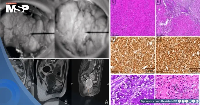 Malacoplaquia cervical simuló neoplasia maligna en mujer inmunocomprometida por miastenia gravis Malacoplaquia cervical simuló neoplasia maligna en mujer inmunocomprometida por miastenia gravis