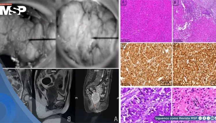 Malacoplaquia cervical simuló neoplasia maligna en mujer inmunocomprometida por miastenia gravis Malacoplaquia cervical simuló neoplasia maligna en mujer inmunocomprometida por miastenia gravis