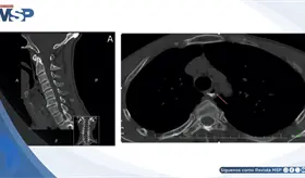 Perforación hipofaríngea simuló lesión menor: disfagia progresiva reveló ruptura de 2.5 cm