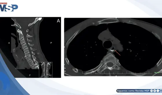 Perforación hipofaríngea simuló lesión menor: disfagia progresiva reveló ruptura de 2.5 cm