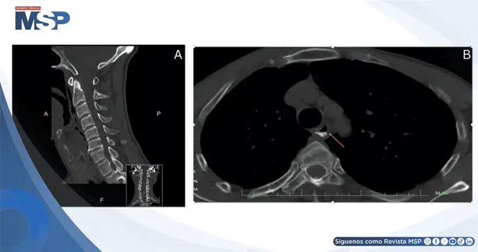 Perforación hipofaríngea simuló lesión menor: disfagia progresiva reveló ruptura de 2.5 cm Perforación hipofaríngea simuló lesión menor: disfagia progresiva reveló ruptura de 2.5 cm