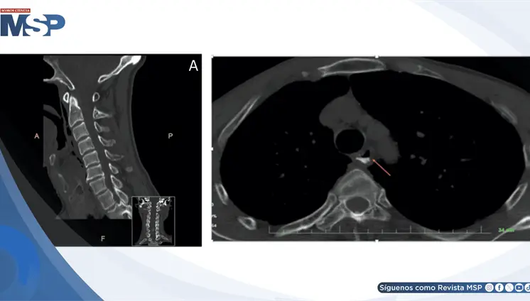 Perforación hipofaríngea simuló lesión menor: disfagia progresiva reveló ruptura de 2.5 cm Perforación hipofaríngea simuló lesión menor: disfagia progresiva reveló ruptura de 2.5 cm