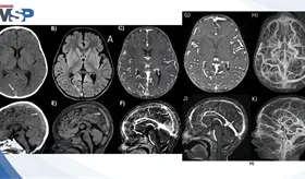 Trombosis venosa cerebral y convulsión focal en niño de 2 años por consumo excesivo de leche de vaca