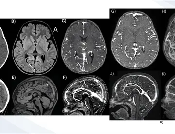 Trombosis venosa cerebral y convulsión focal en niño de 2 años por consumo excesivo de leche de vaca