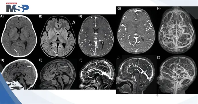 Trombosis venosa cerebral y convulsión focal en niño de 2 años por consumo excesivo de leche de vaca