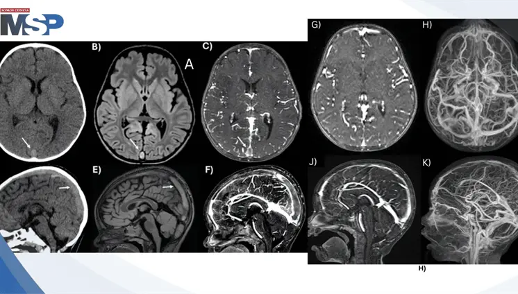 Trombosis venosa cerebral y convulsión focal en niño de 2 años por consumo excesivo de leche de vaca