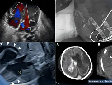 Bradicardia fetal y derrame pericárdico como señales de infección intrauterina por herpes simple en feto