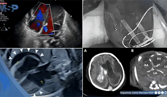 Bradicardia fetal y derrame pericárdico como señales de infección intrauterina por herpes simple en feto