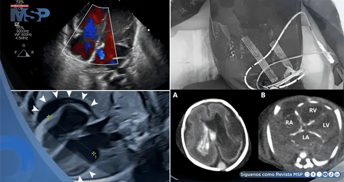 Bradicardia fetal y derrame pericárdico como señales de infección intrauterina por herpes simple en feto