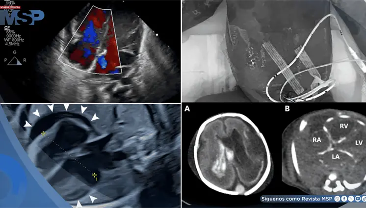 Bradicardia fetal y derrame pericárdico como señales de infección intrauterina por herpes simple en feto Bradicardia fetal y derrame pericárdico como señales de infección intrauterina por herpes simple en feto