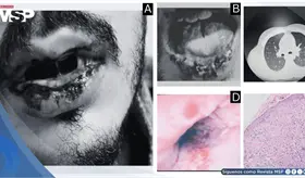 Síndrome de Fuchs inducido por levofloxacina se ocultó tras mucositis severa sin lesiones cutáneas